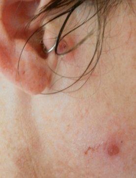  school sores lesions ( impetigo) in adult , caught from child. caused by staphylococcus horrible tropical disease