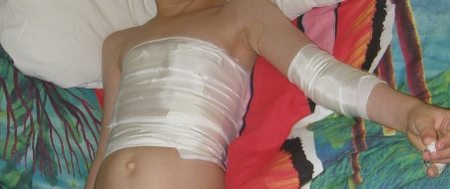 School sores or impetigo lesions need to be covered and kept clean. Dressings need to be changed frequently as treatment is applied.